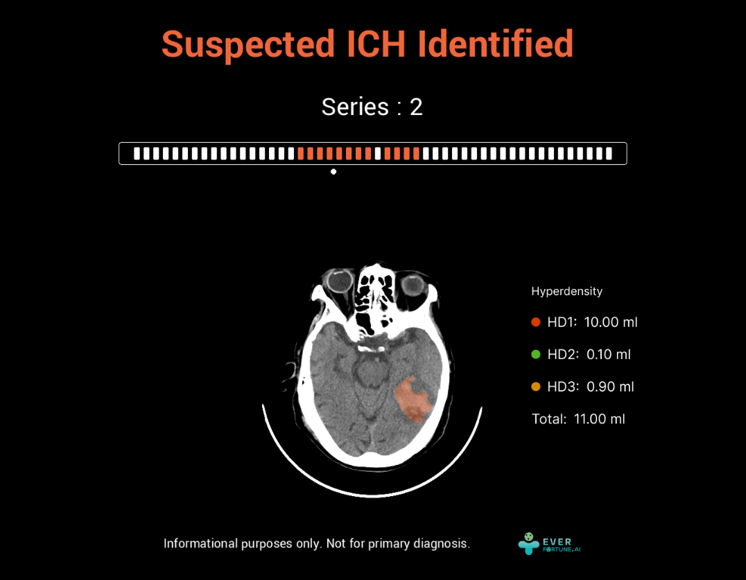腦出血檢測系統- EverFortune.ai