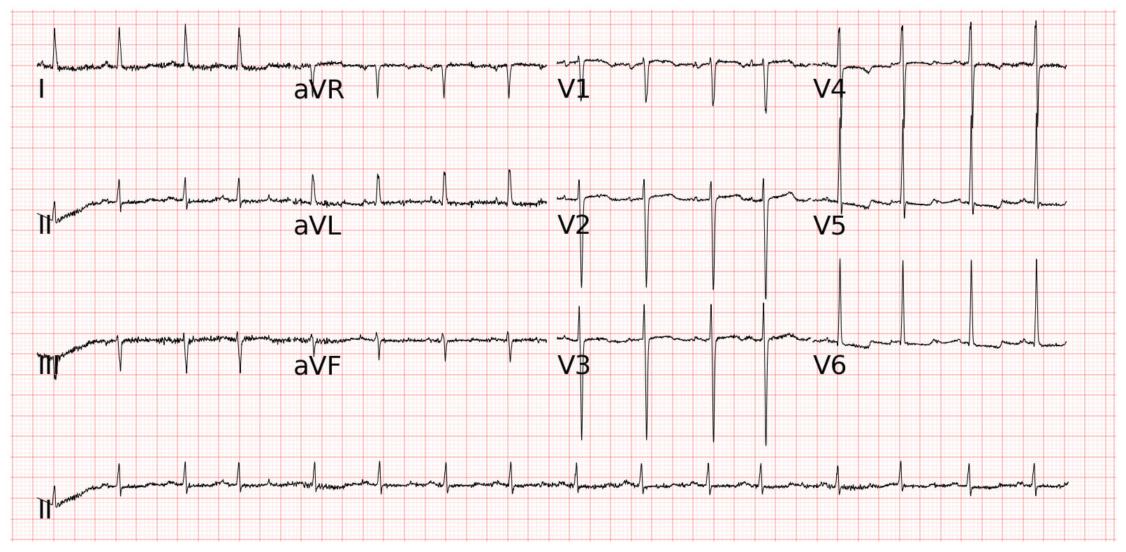Atrial premature beat心房早期收縮
