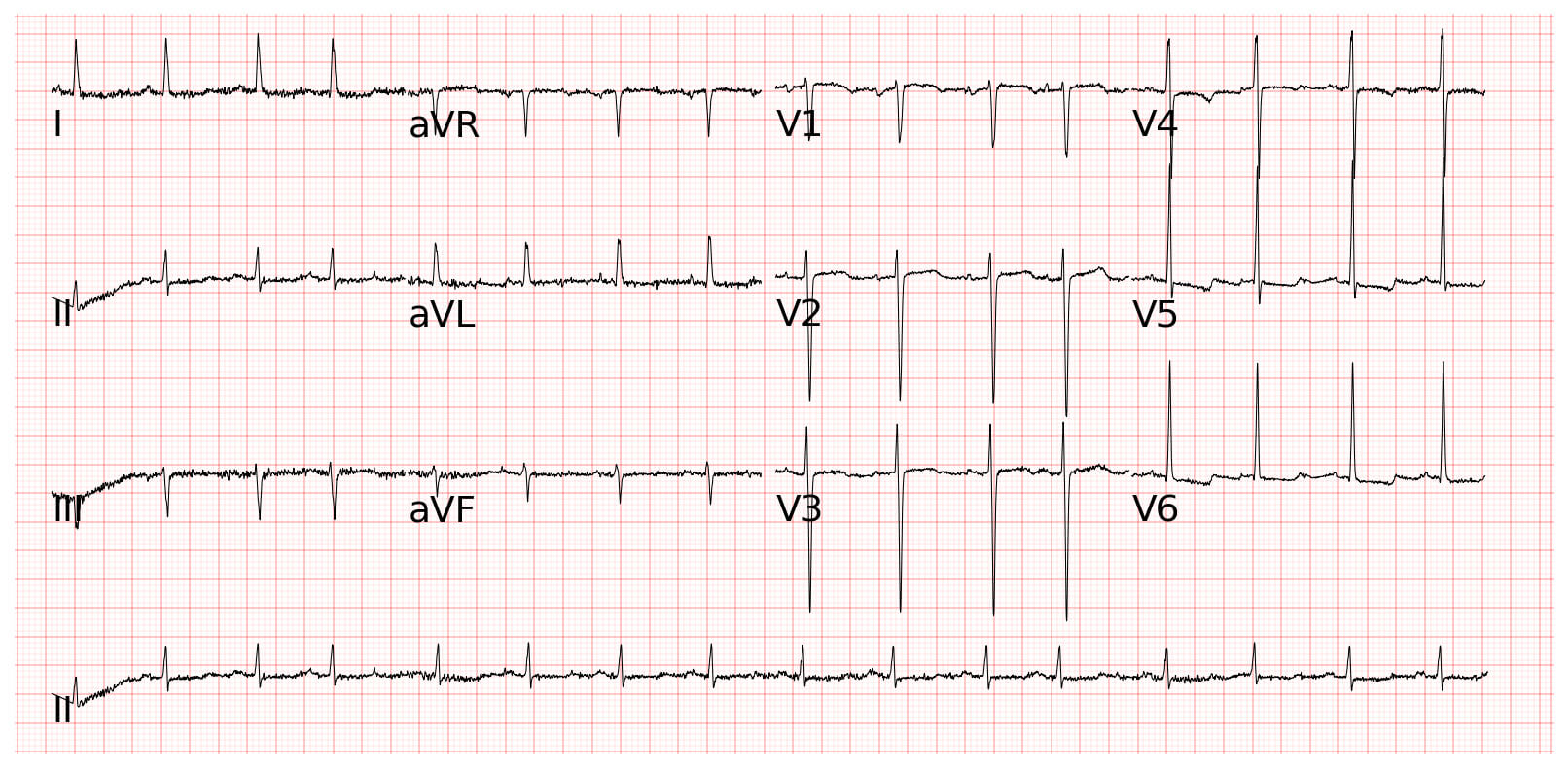 Atrial premature beat心房早期收縮