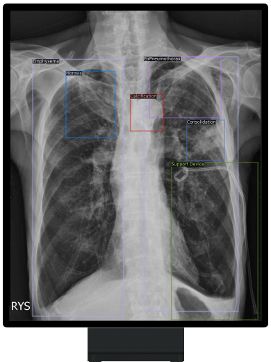 人工智能輔助胸部X光診斷系統