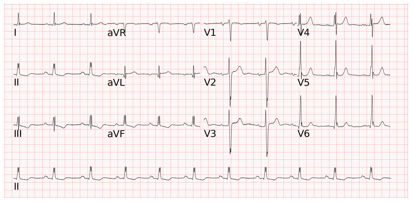 First-degree AV block第一度房室傳導阻滯