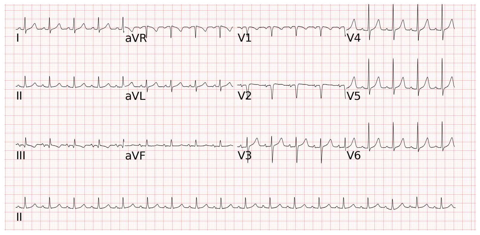 Sinus tachycardia竇性心律過快