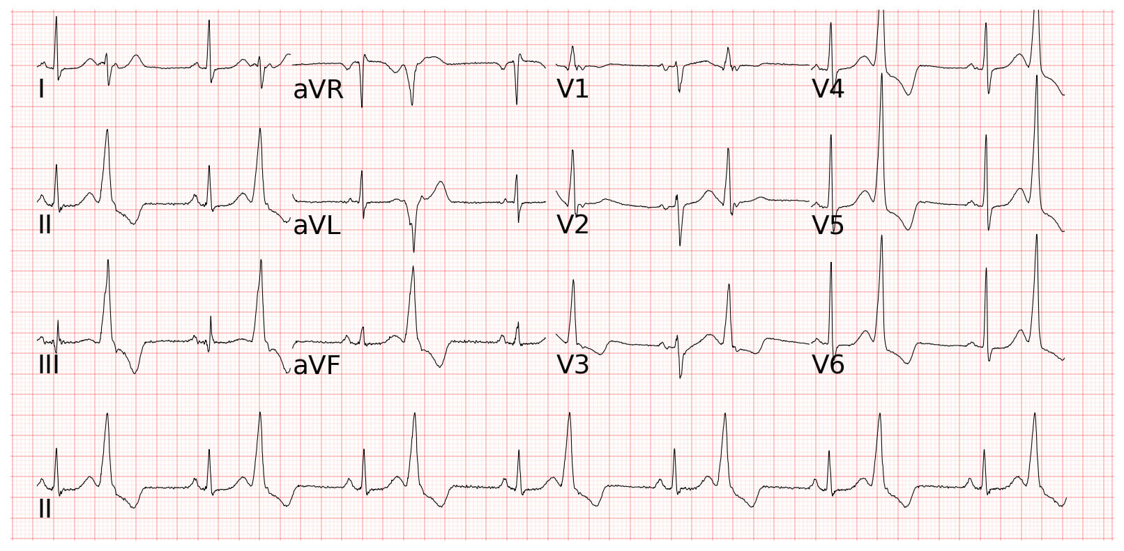 Ventricular Bigeminy 單純雙聯律心跳特徵