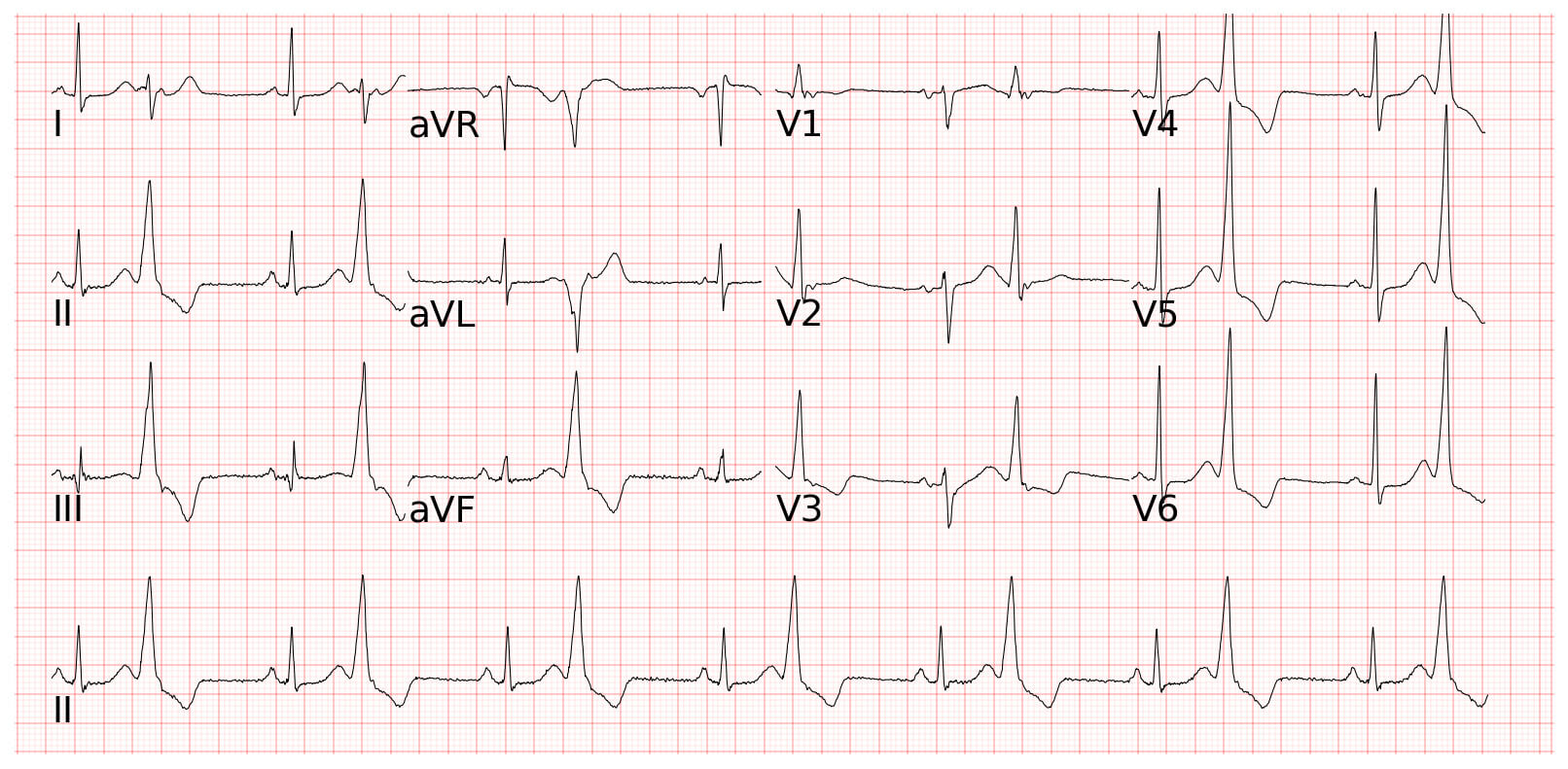 Ventricular Bigeminy 單純雙聯律心跳特徵